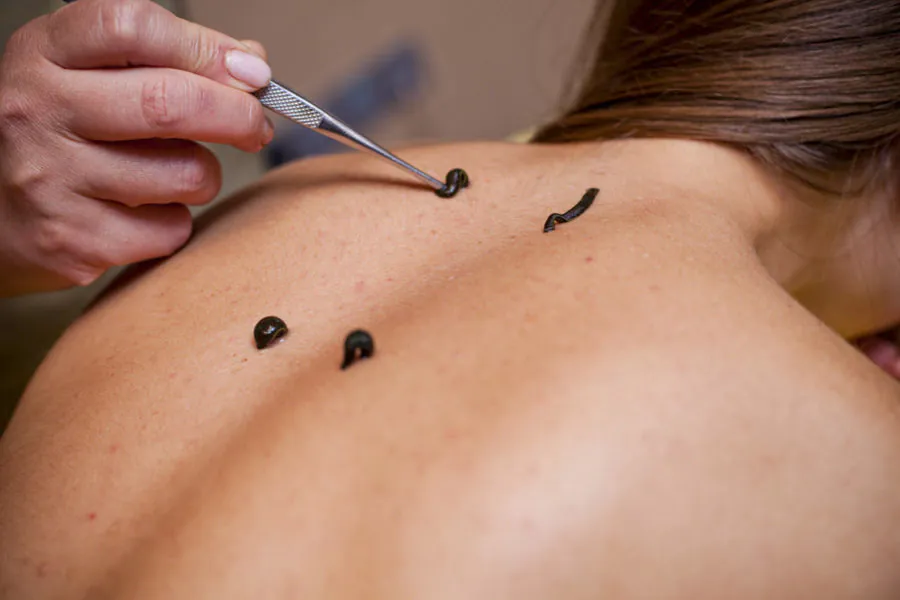 Гирудотерапия в санатории «Родник» в Кисловодске - фотография